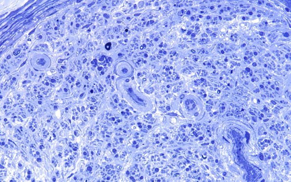 14F3 End Stage Nerve (Case 14) Plastic 60X