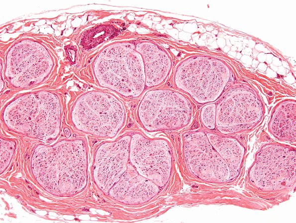 15A1 End stage nerve (Case 15) H&E 1