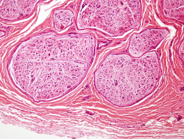 15A2 End stage nerve (Case 15) H&E 2