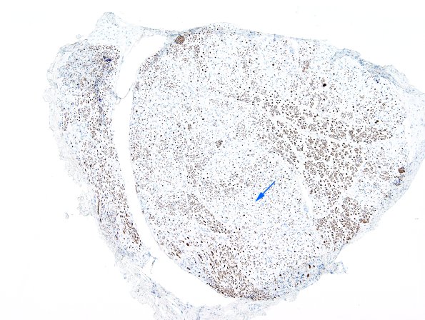 16A1 Axon Loss, Sciatic (Case 16) 1 NF 3 copy