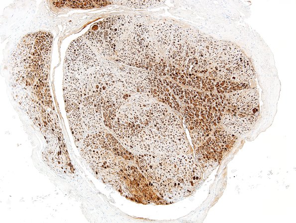 16A2 Axon Loss, Sciatic (Case 16) 1 S100 3