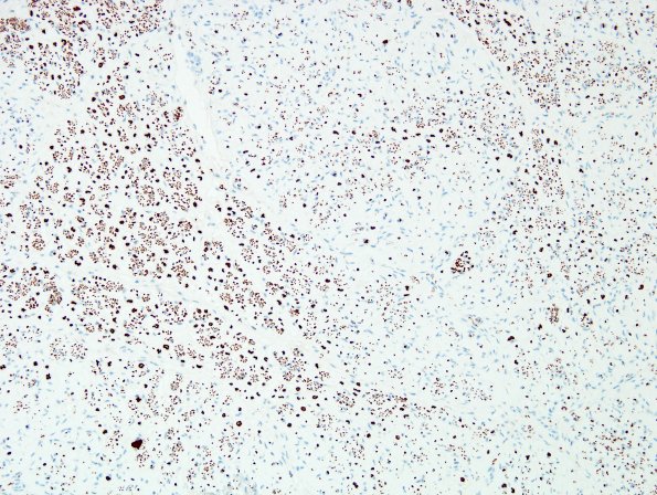 16A3 Axon Loss, Sciatic (Case 16) NF 2