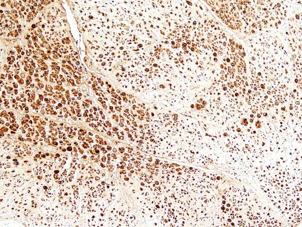 16A4 Axon Loss, Sciatic (Case 16) S100 2