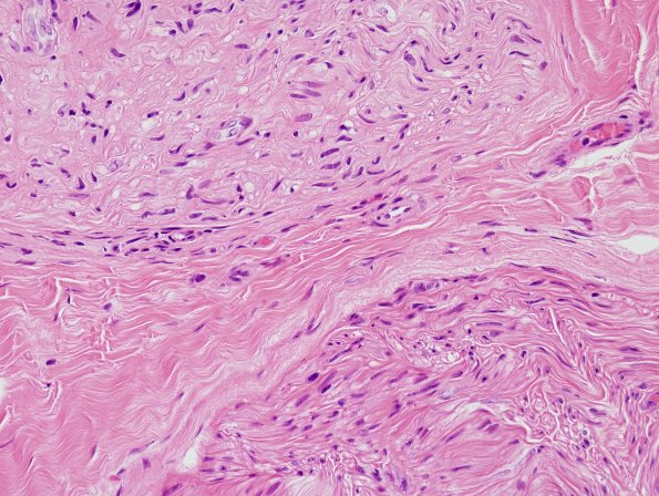 17A2 Axonal degeneration-regeneration (Case 17) H&E 2.jpg