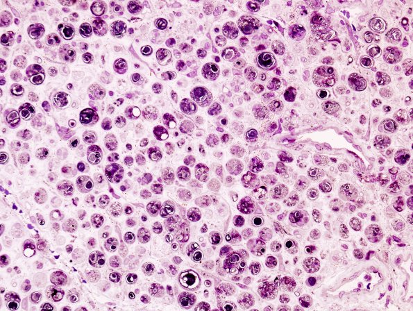 1A1 Axonal Degeneration fibroblasts WD (Case 1) 1A