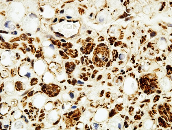 1B3 Regeneration NF (Case 1)A