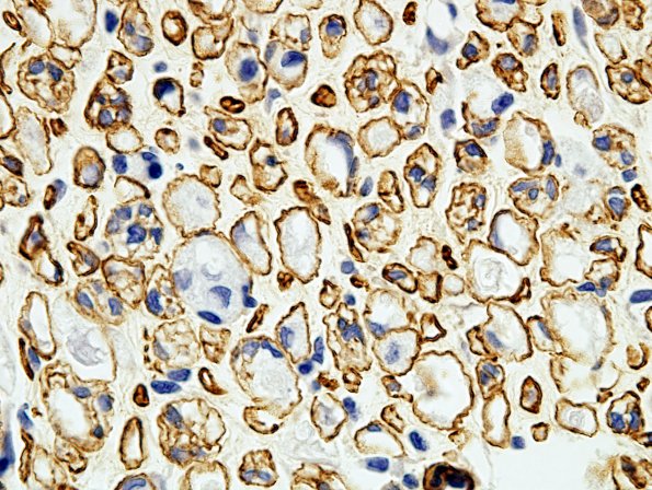 1C1 Regeneration Coll IV (Case 1) aA