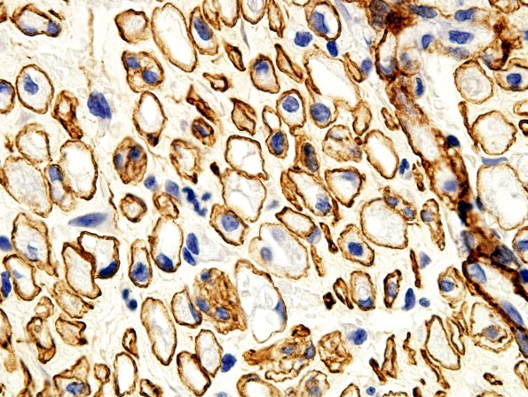 1C2 Regeneration Coll IV (Case 1) bA