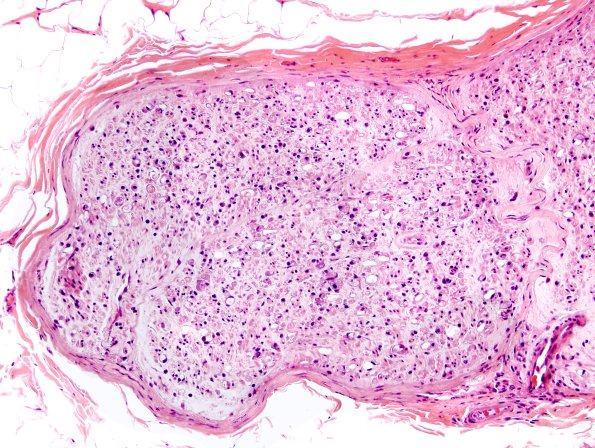 2A1 Axonal Degeneration (Case 2) H&E 3 (2)