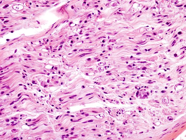 2A2 Axonal Degeneration (Case 2) H&E 4
