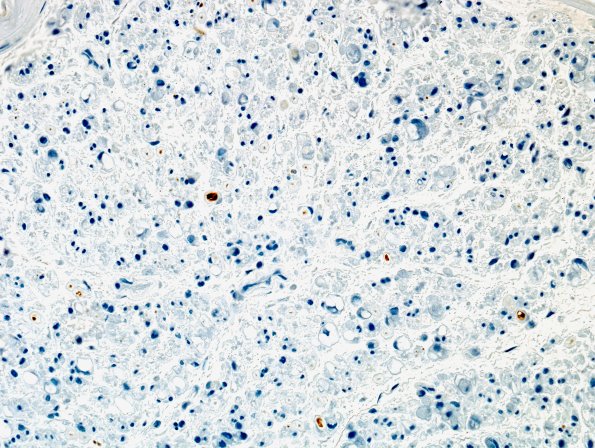 2B Axonal Degeneration (Case 2) distal to vasculitis NFil 1