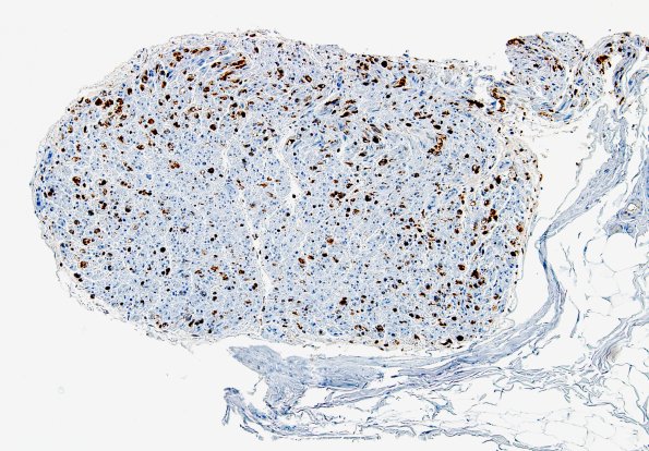 2C1 Axonal Degeneration (Case 2) distal to vasculitis CD-68 4