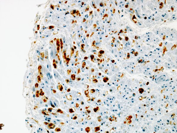 2C2 Axonal Degeneration (Case 2) distal to vasculitis CD-68 1