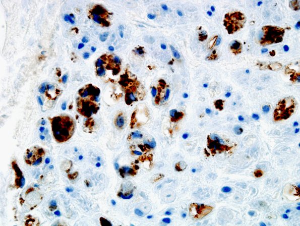 2C3 Axonal Degeneration (Case 2) distal to vasculitis CD-68 2