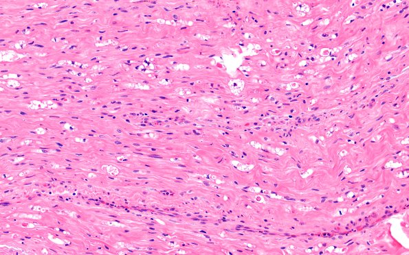 3A2 Axonal Degeneration (Case 3) H&E 20X