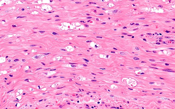 3A3 Axonal Degeneration (Case 3) H&E 40X