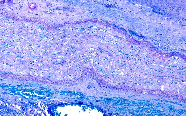 3B1 Axonal Degeneration (Case 3) LFB-PAS 10X