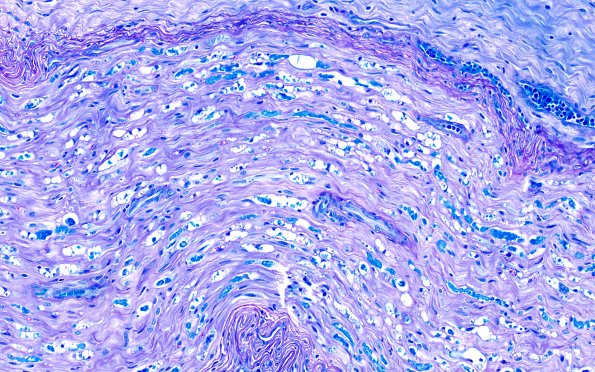 3B2 Axonal Degeneration (Case 3) LFB-PAS 20X