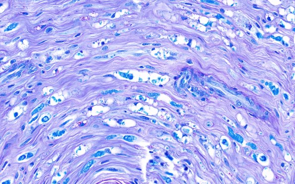 3B3 Axonal Degeneration (Case 3) LFB-PAS 40X