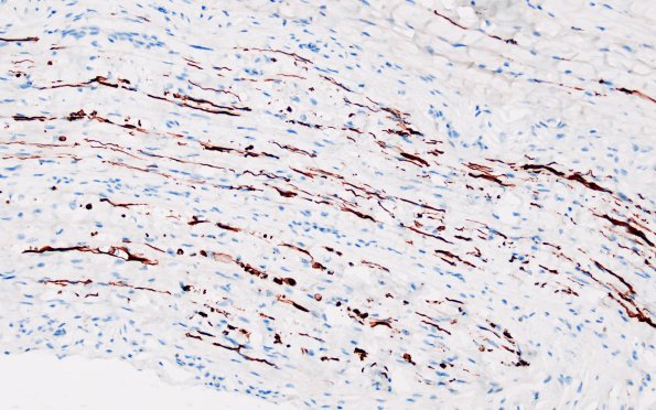 3C1 Axonal Degeneration (Case 3) NF 2