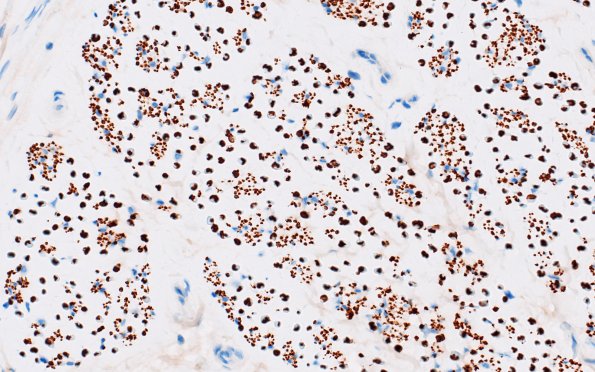 3C4 Axonal Degeneration (Case 3) NF 40X 1A