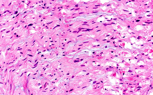 4A2 Axonal Degeneration (Case 4) H&E 2