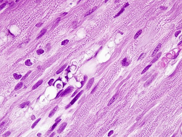5A2 Axonal degeneration, Monkey (ZOO) 3