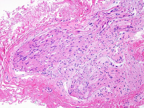6A1 Axonal Degeneration (Case 6) H&E 1