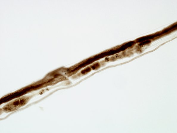 7A2 Axonal degeneration, teased fiber (Case 7) 1