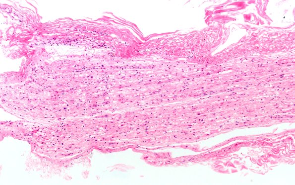 7B1 Ovoids (Case 7) H&E 10X