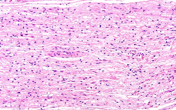 7B3 Ovoids (Case 7) H&E 20X