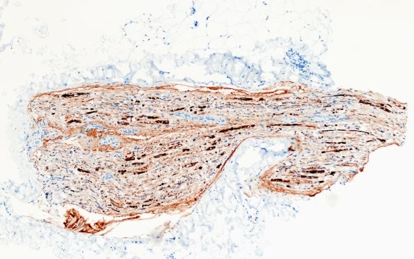 7C1 Ovoids (Case 7) NF 10X