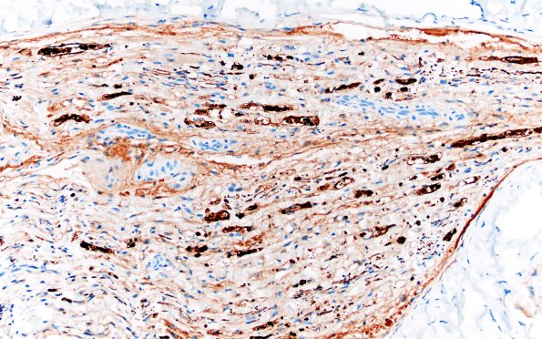 7C2 Ovoids (Case 7) NF 20X