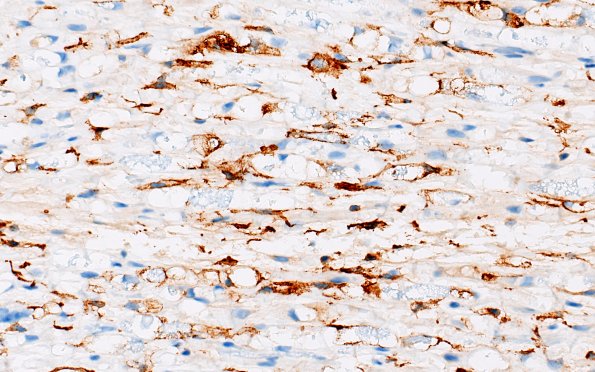 7D2 Ovoids (Case 7) CD163 40X