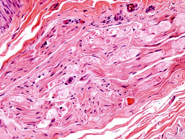 8A1 Axonal Degeneration (Case 8) H&E 4