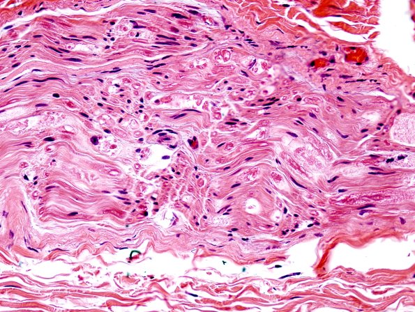 8A2 Axonal Degeneration (Case 8) H&E 2