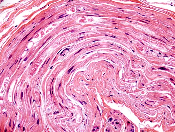 8A3 Axonal Degeneration (Case 8) H&E 3