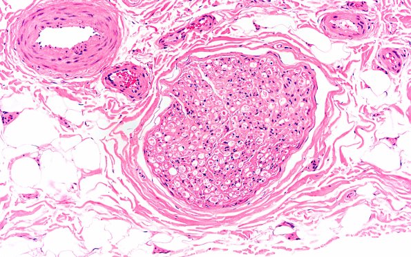9A2 Axonal Degeneration, fulminant (Case 9) H&E 8