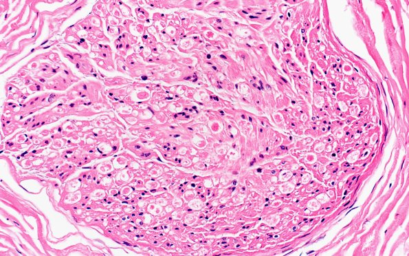 9A3 Axonal Degeneration, fulminant (Case 9) H&E 1
