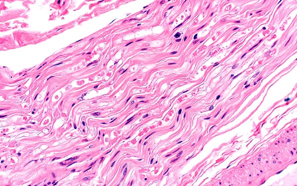 9A4 Axonal Degeneration, fulminant (Case 9) H&E 4
