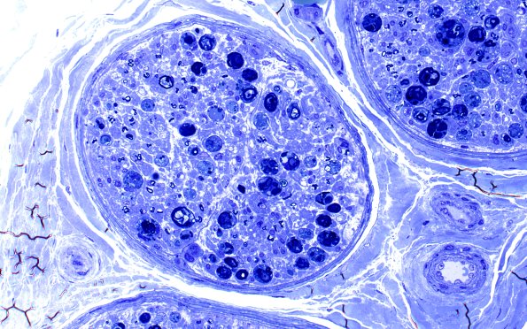 9B Bucelli Lesions (Case 9) Plastic 40X