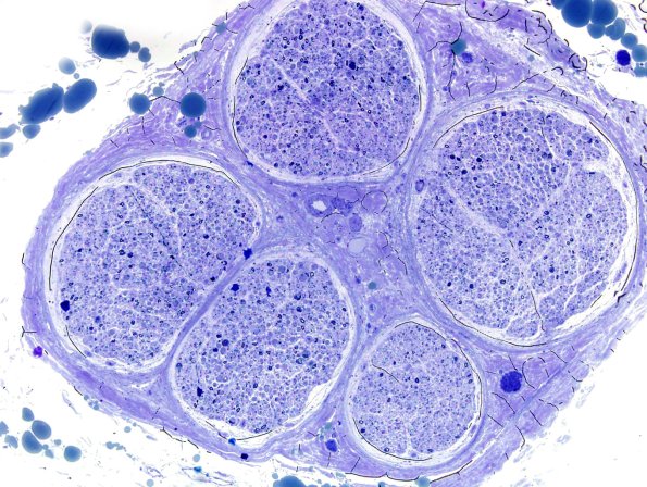 10A1 Axonal Degeneration, fulminant (Case 10) Plastic 10X
