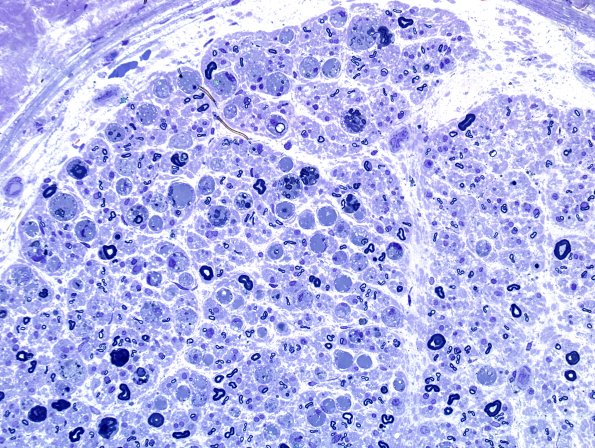 10A2 Axonal Degeneration, fulminant (Case 10) Plastic 4.jpg
