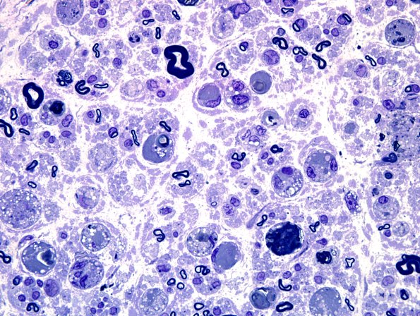 10A3 Axonal Degeneration, fulminant (Case 10) Plastic 100X 1.jpg