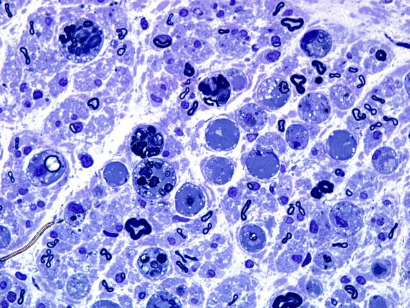 10A4 Axonal Degeneration, fulminant (Case 10) Plastic 100X 5.jpg