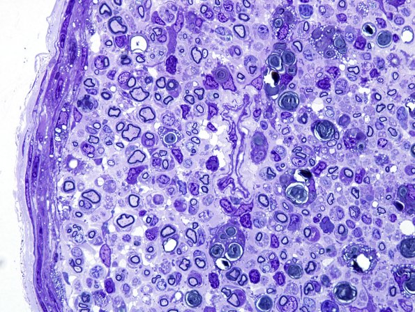 11A4 Mouse sciatic (Case 11) Plastic 100X 3.jpg