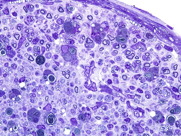 11A5 Mouse sciatic (Case 11) Plastic 100X 4.jpg