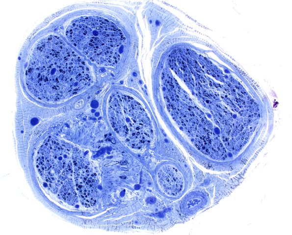 12A1 Axonal Swellings, fascicle (Case 12) Plastic 4