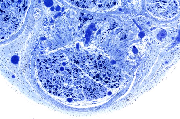 12A2 Axonal Swellings, fascicle (Case 12) Plastic 3