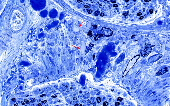 12A3 Axonal Swellings, fascicle (Case 12) Plastic 1 copy